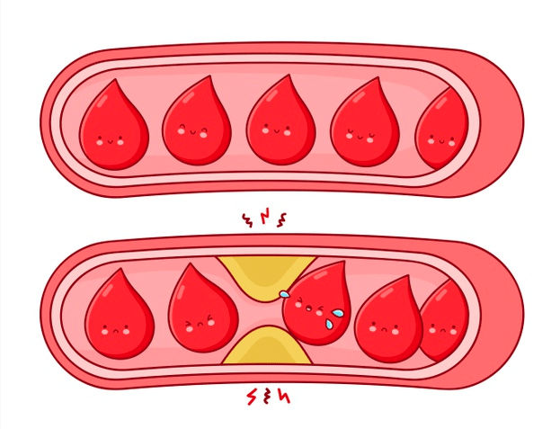 Wat is cholesterol in het bloedvat